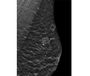 DBT x-ray shows several calcifications in area of reported pain